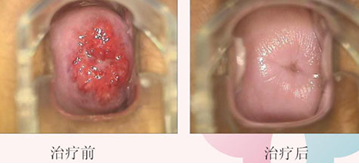 患者亲述：太原哪里治疗宫颈糜烂好(图2)