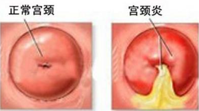 必看：宫颈炎有效的治疗方法(图1)